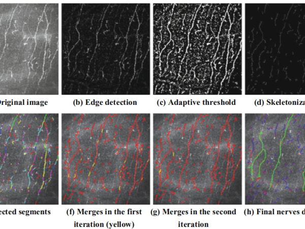 Automatic Detection of Nerves in Confocal Corneal Images with Orientation-Based Edge Merging