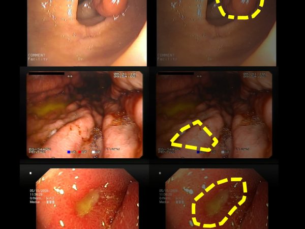 ERS: a novel comprehensive endoscopy image dataset for machine learning, compliant with the MST 3.0 specification