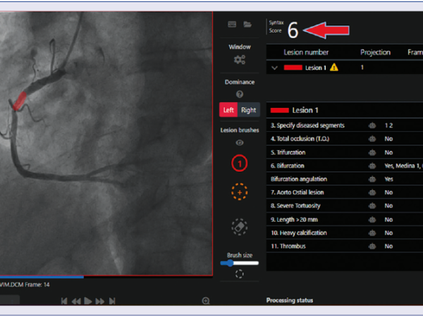 AngioScore: An artificial intelligence tool to assess coronary artery lesions