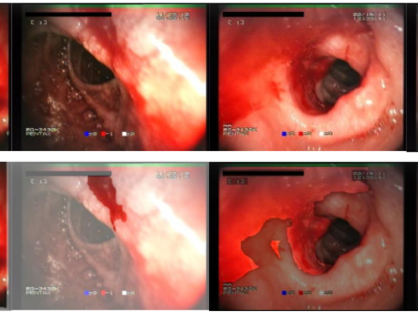 An overview of image analysis techniques in endoscopic bleeding detection