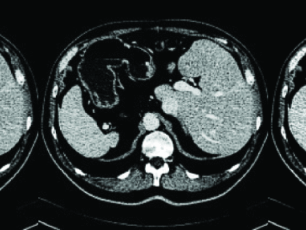 Comparison of image pre-processing methods in liver segmentation task