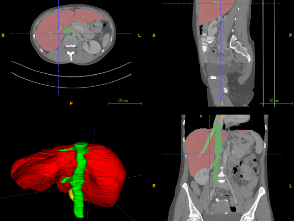 3D liver segmentation & reconstruction