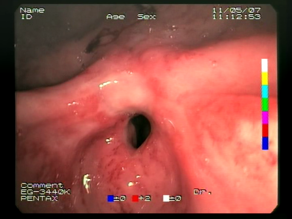 Endoscopy Recommender System