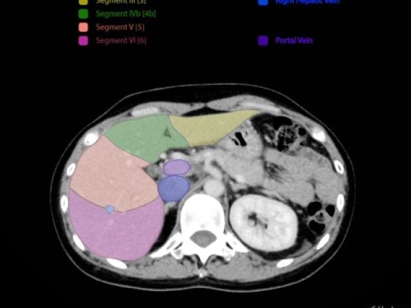 Comparison of Selected Neural Network Models Used for Automatic Liver Tumor Segmentation